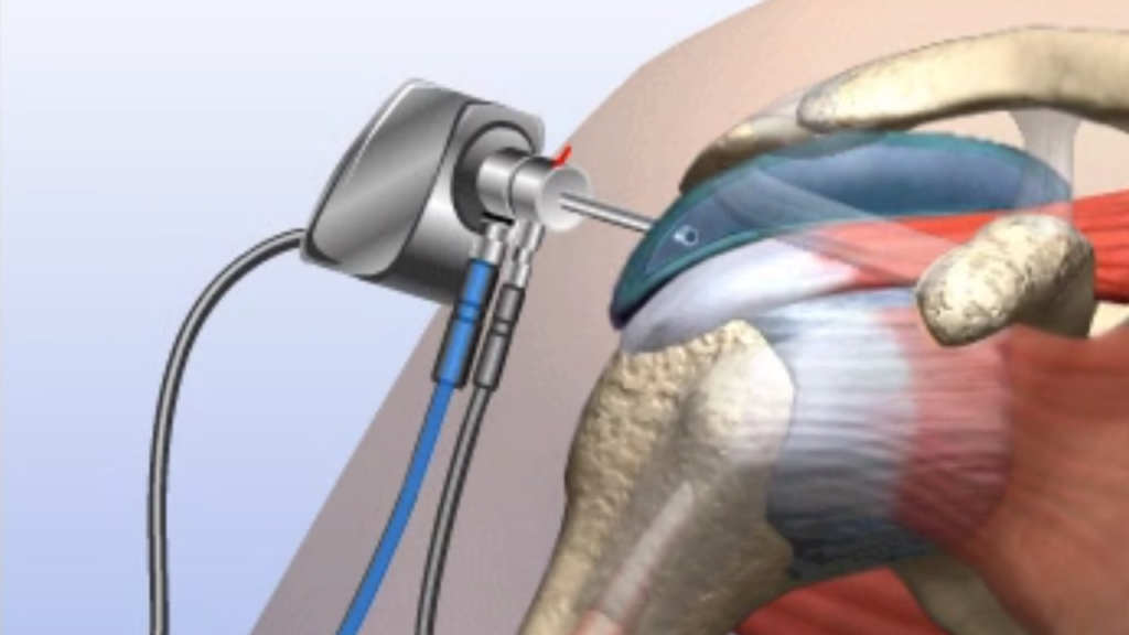 Subacromial Impingement - Dr. Chakradhar